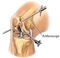 Arthroscopic Surgery