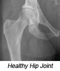 Healthy Hip Joint