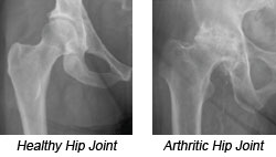 xray of normal hip joint vs osteoarthritic